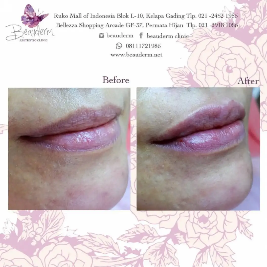 Lips Filler / Filler Bibir